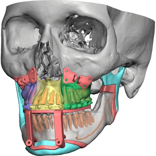 VSP Orthognathics | 3D Systems