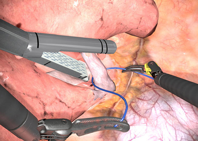 Robotic Lobectomy | 3D Systems