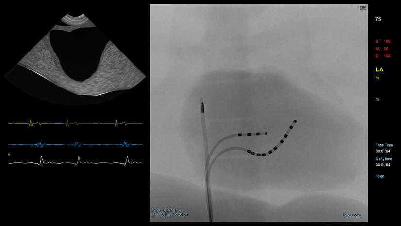 AF Ablation | 3D Systems